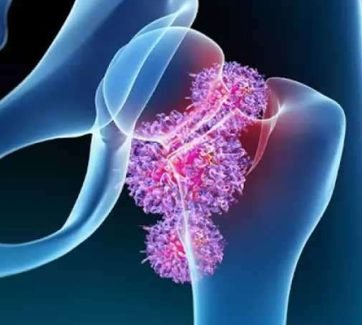 bone-tumors